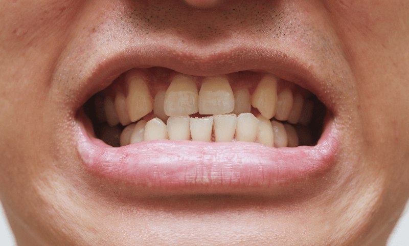 6 Types of Crossbite Conditions - Diamond Braces