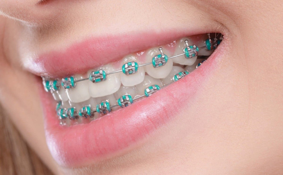Broken or Loose Bracket from Braces - Diamond Braces