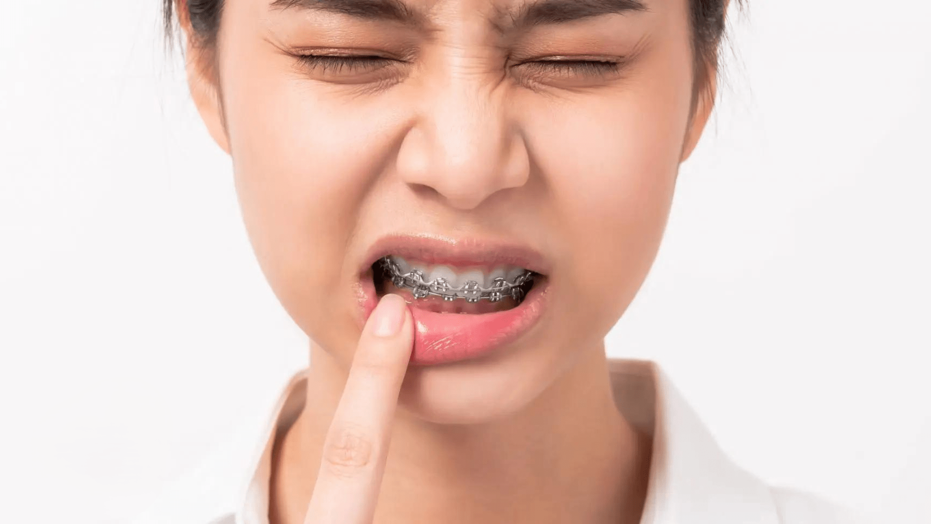 Canker Sores, Irritated Lips & Gums from Braces - Diamond Braces