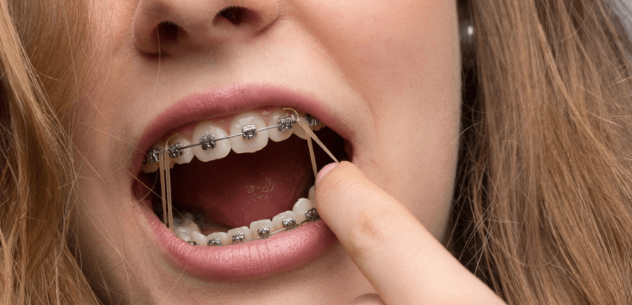 Elastic Bands Come Off or Loosen on Braces - Diamond Braces