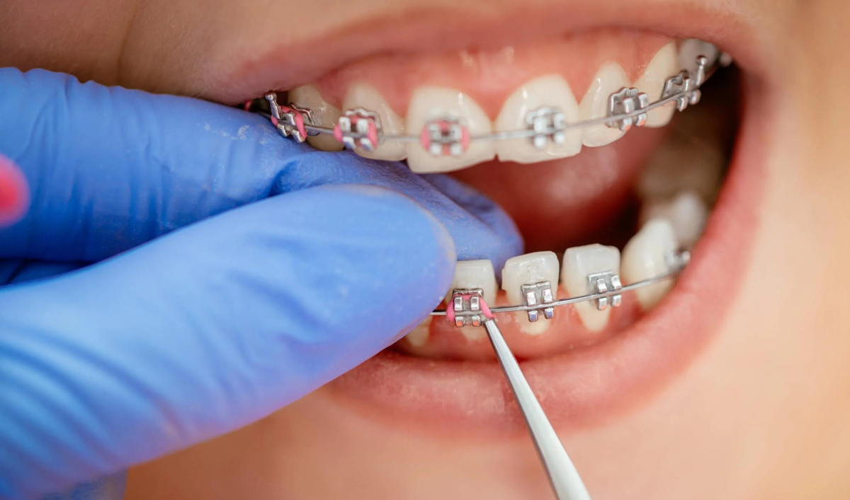 metal braces with pink elastic ligatures being added in from Diamond Braces
