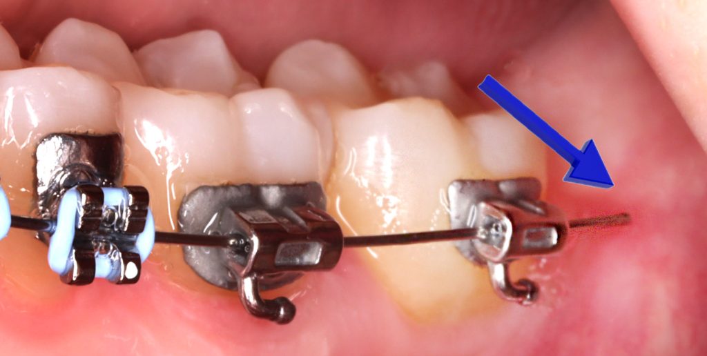 Wire Poking Your Cheeks or Gums from Braces - Diamond Braces