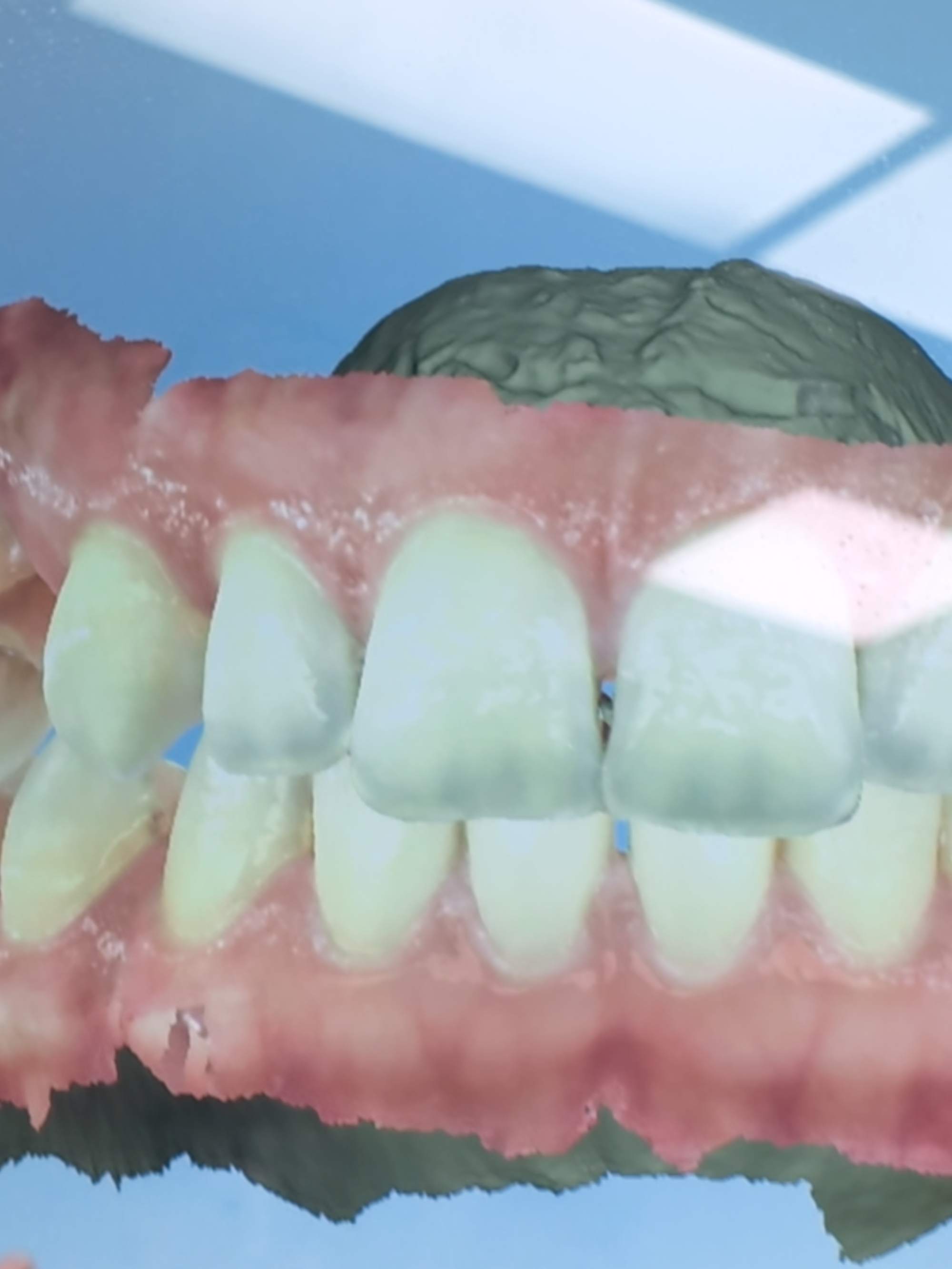Invisalign Treatment Scan at Diamond Braces