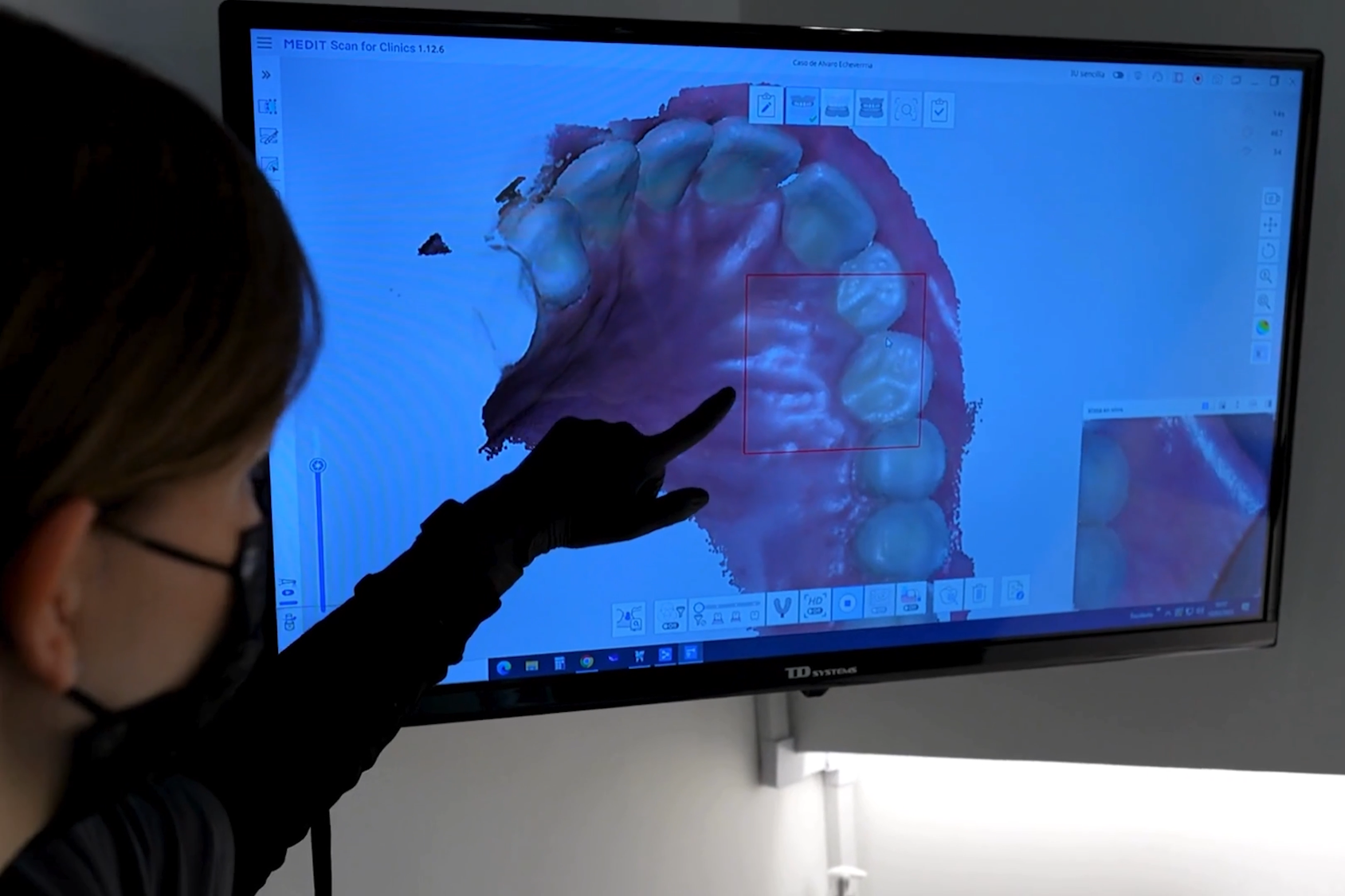 Display of teeth scan from invisalign treatment at Diamond Braces