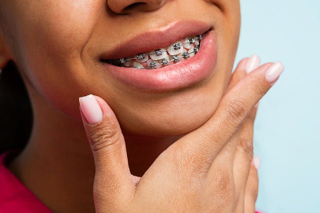 12 Months - Diamond Braces