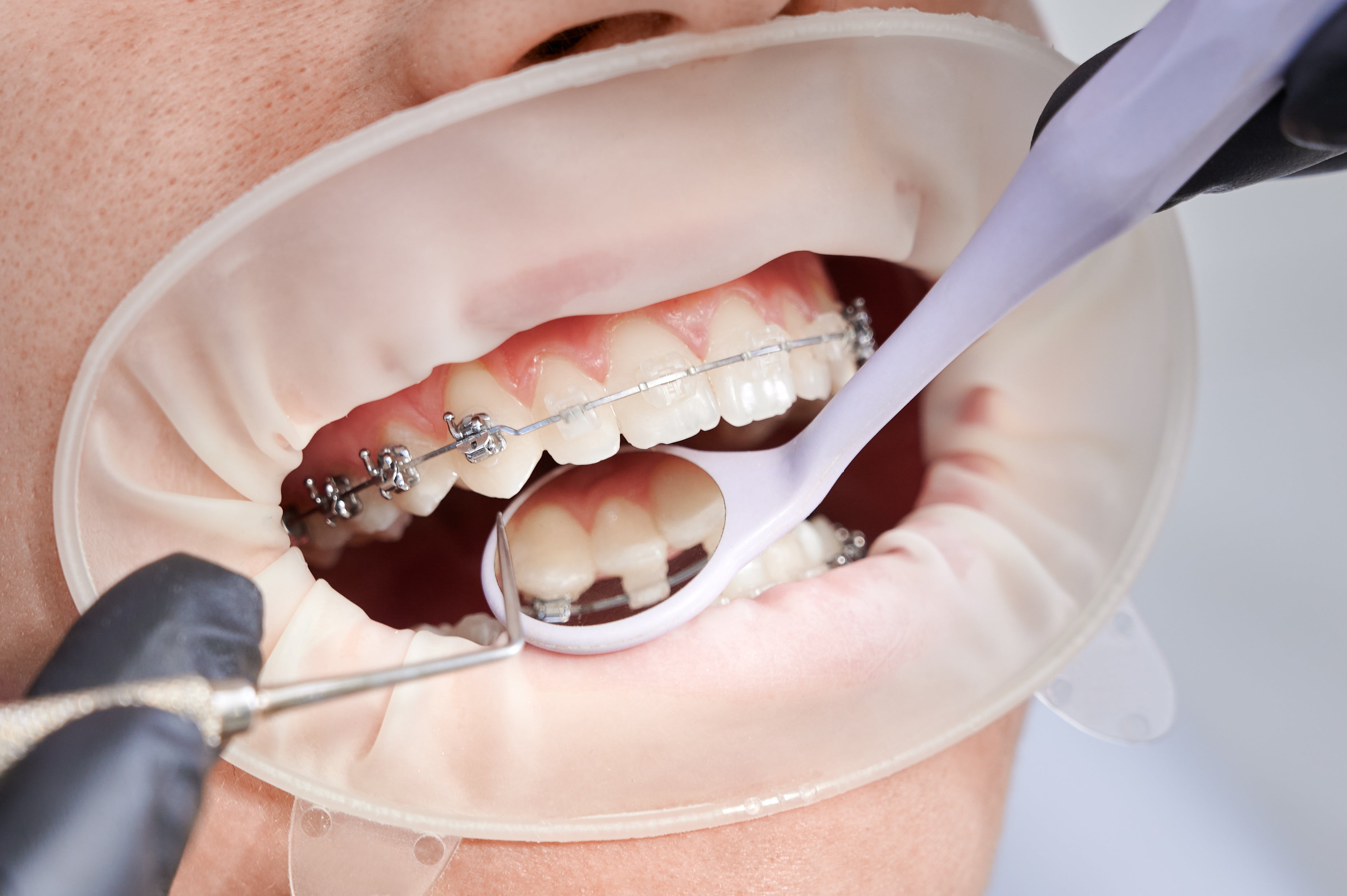 Can You Get Braces with Cavities