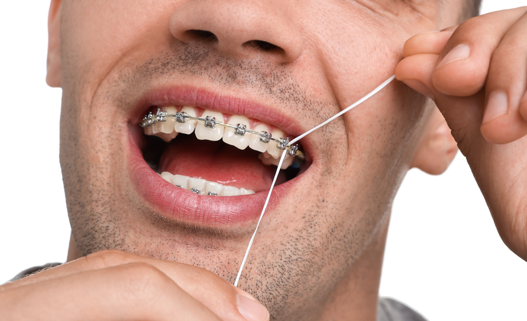 How to Floss with Braces