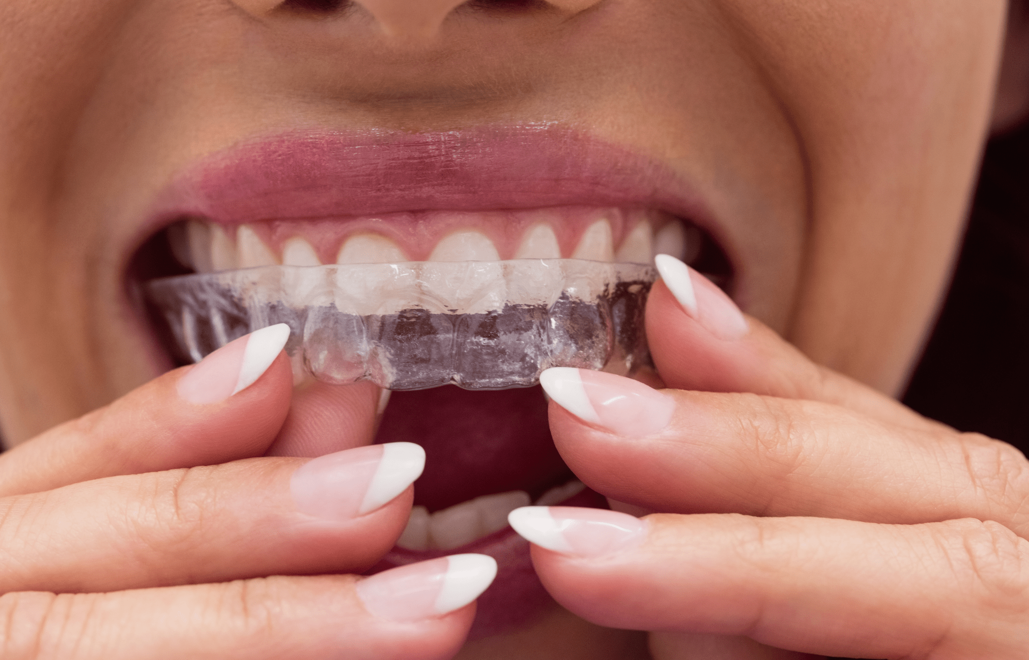 Angel Aligners vs Invisalign: Full Comparison Guide - Diamond Braces