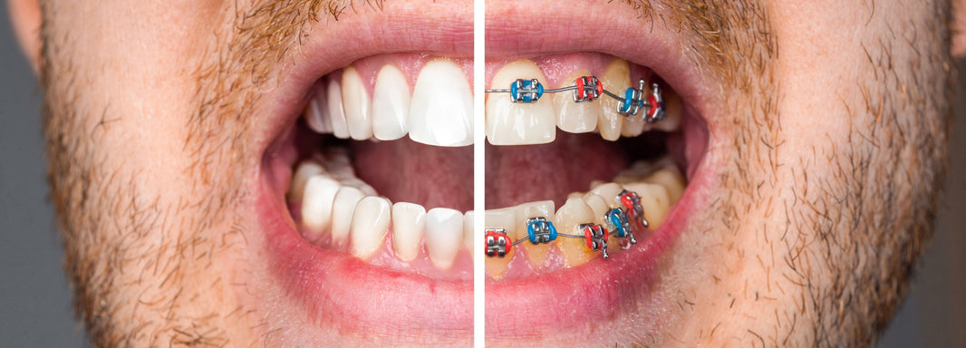 Braces Before and After: What to Expect From Your Treatment - Diamond Braces