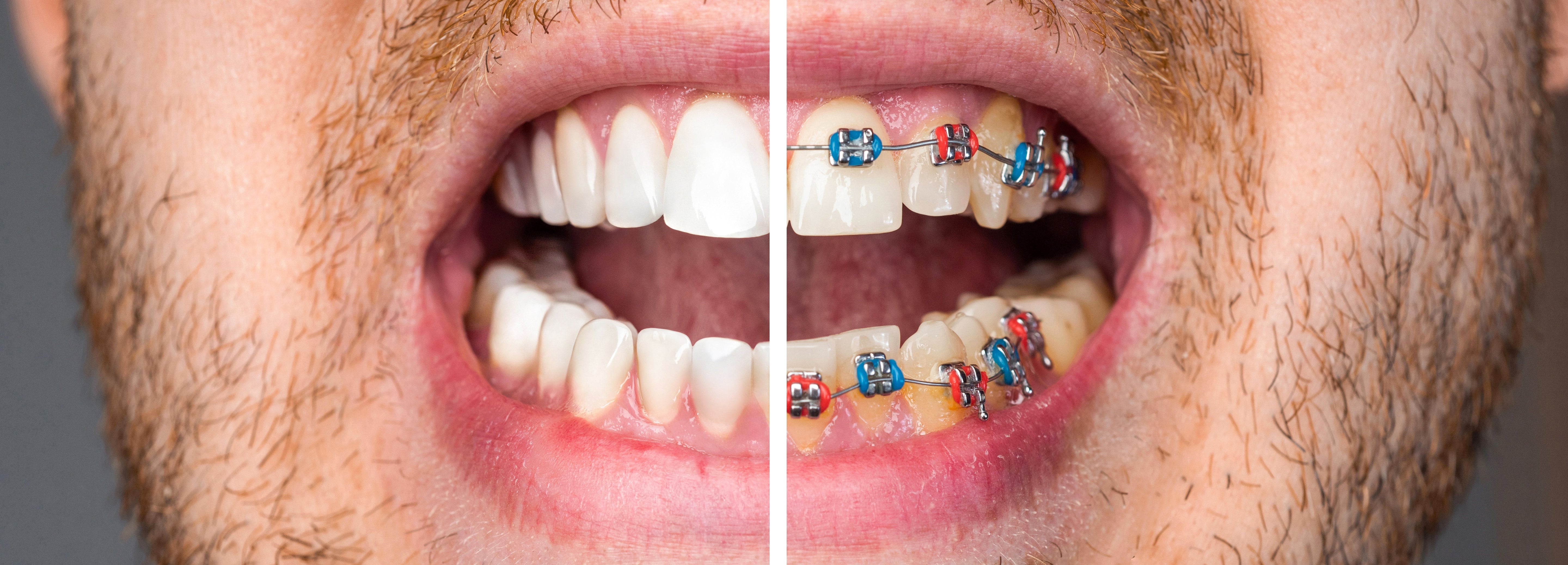 Braces Before and After: What to Expect From Your Treatment - Diamond Braces