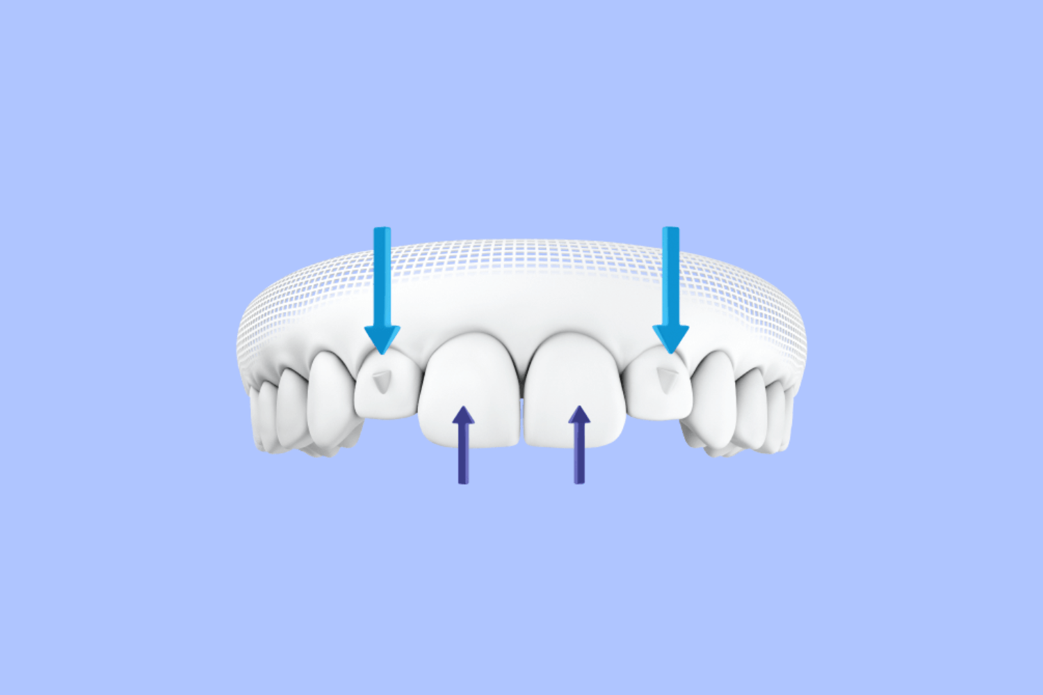 Invisalign Buttons Example Broken Elastic Button on Invisalign Aligners – Diamond Braces