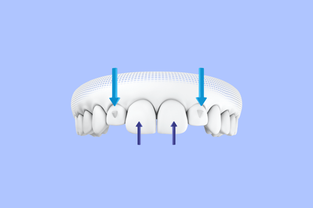 Broken Elastic Button on Invisalign Aligners – Diamond Braces
