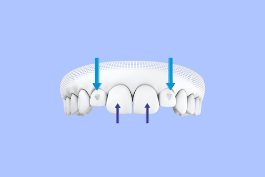 Broken Elastic Button on Invisalign Aligners – Diamond Braces