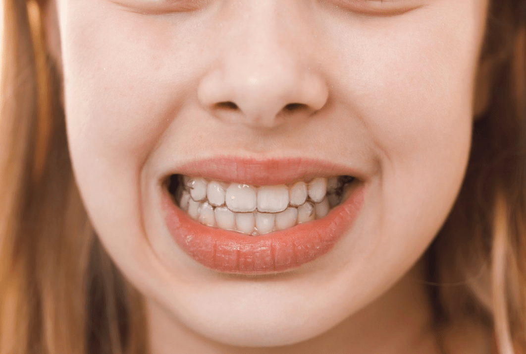 Can Invisalign Fix Overbite? What Adults and Teens Should Know - Diamond Braces
