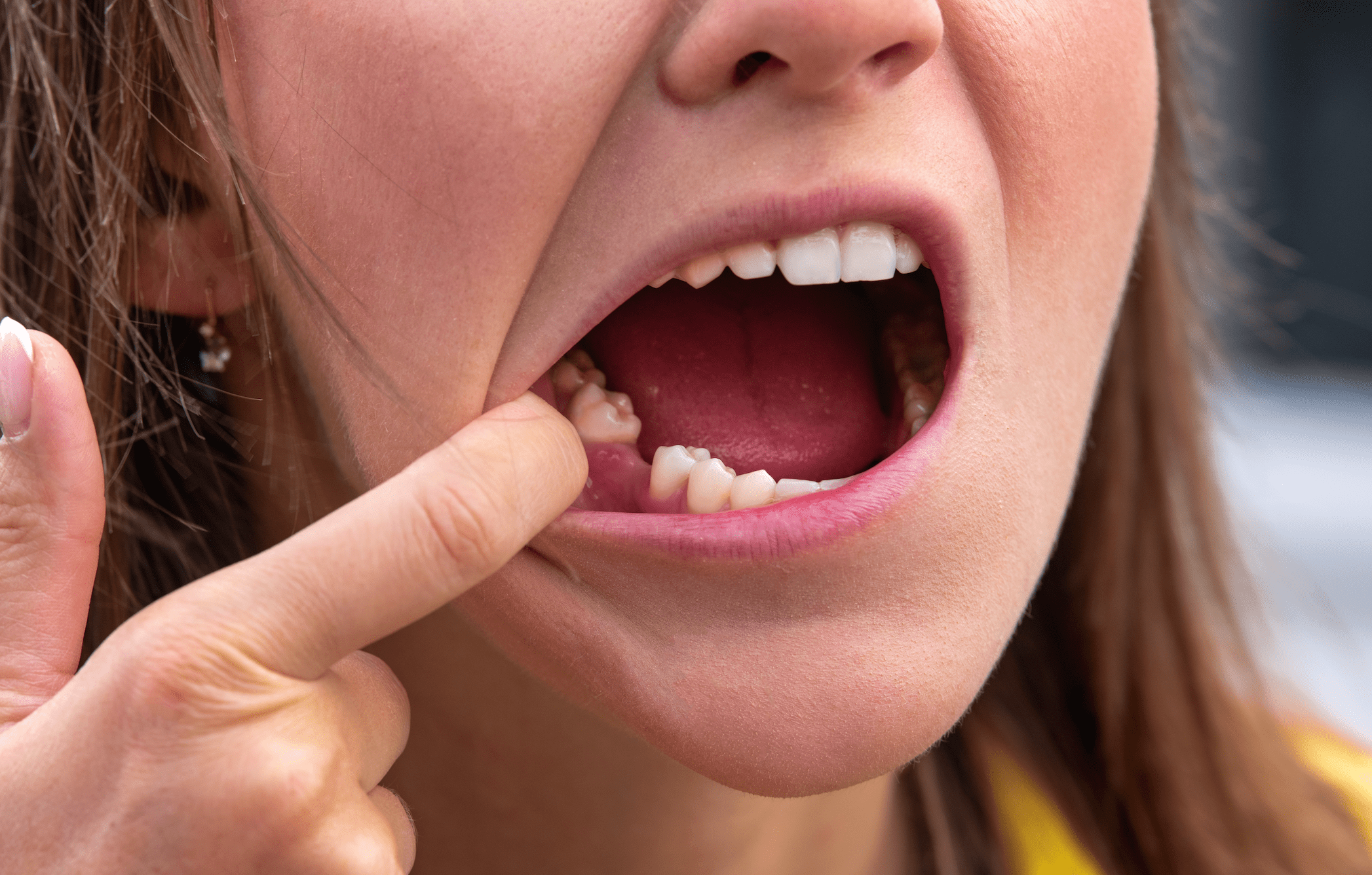 Can You Get Braces with Missing Teeth? - Diamond Braces