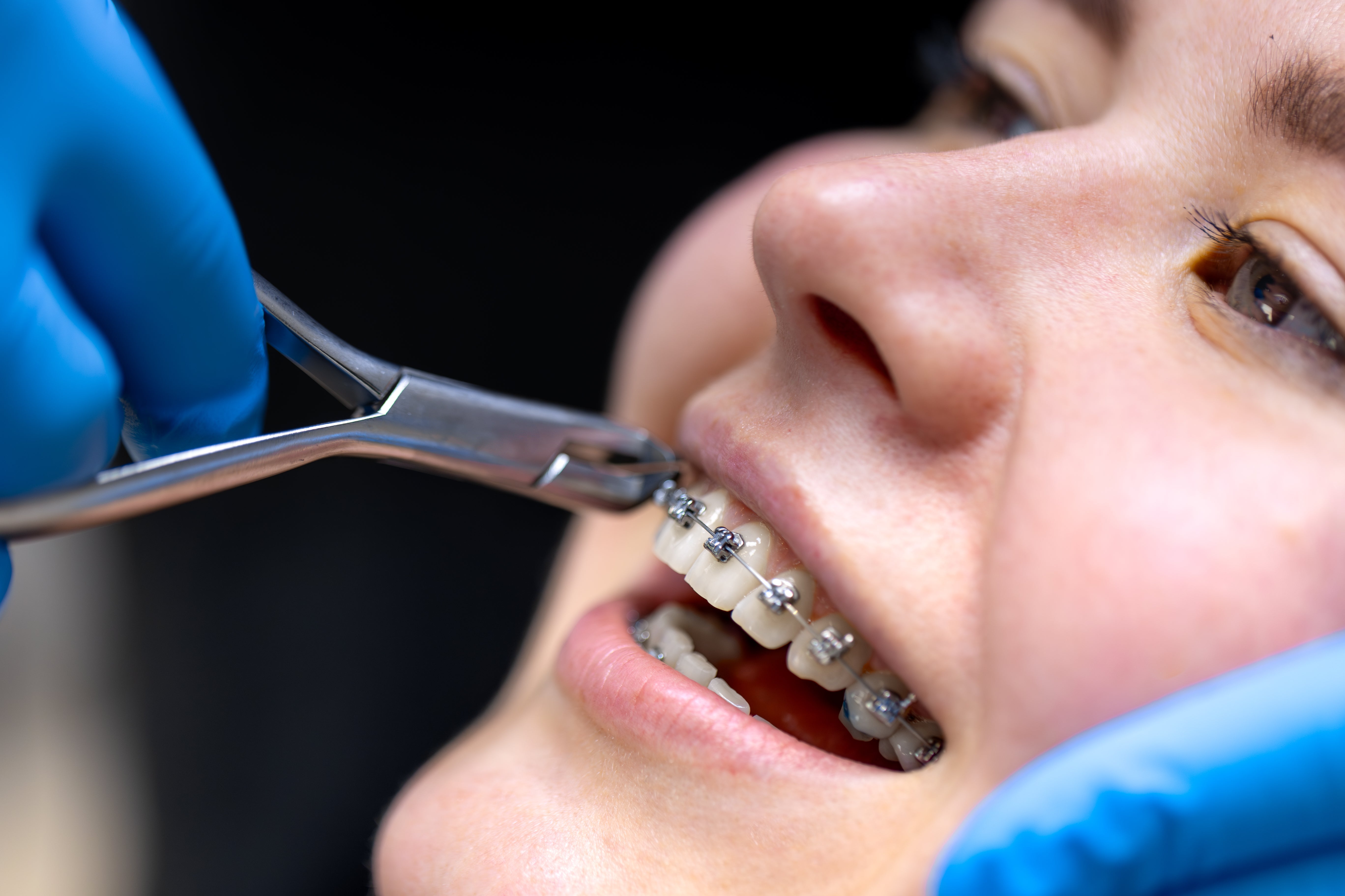 Can You Remove Braces at Home? What to Do Instead - Diamond Braces