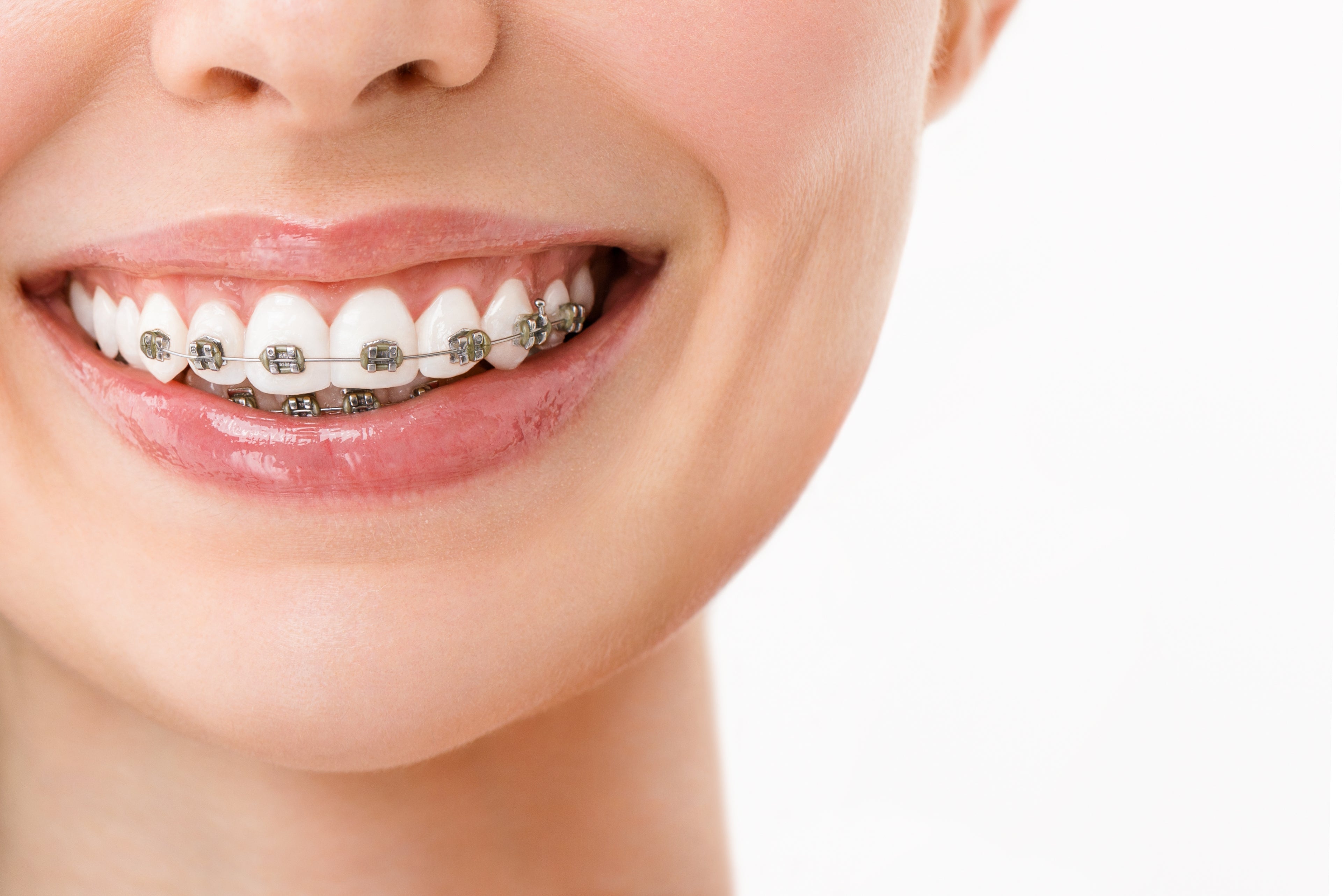 Can You Use Whitening Strips with Braces? The Honest Answer - Diamond Braces