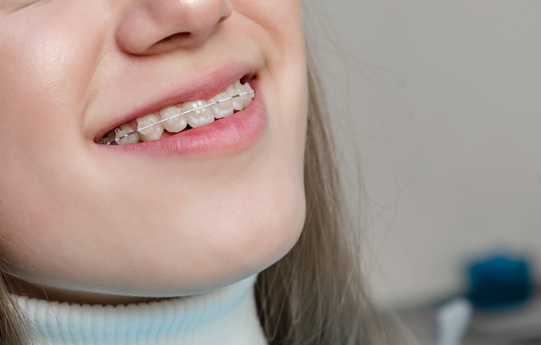 Ceramic Braces vs Metal Braces: Pros, Cons, Cost, and Which Is Right for You - Diamond Braces