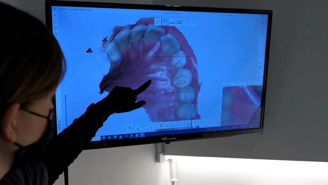 Crossbite Symptoms, Causes and How Orthodontists Treat Them - Diamond Braces