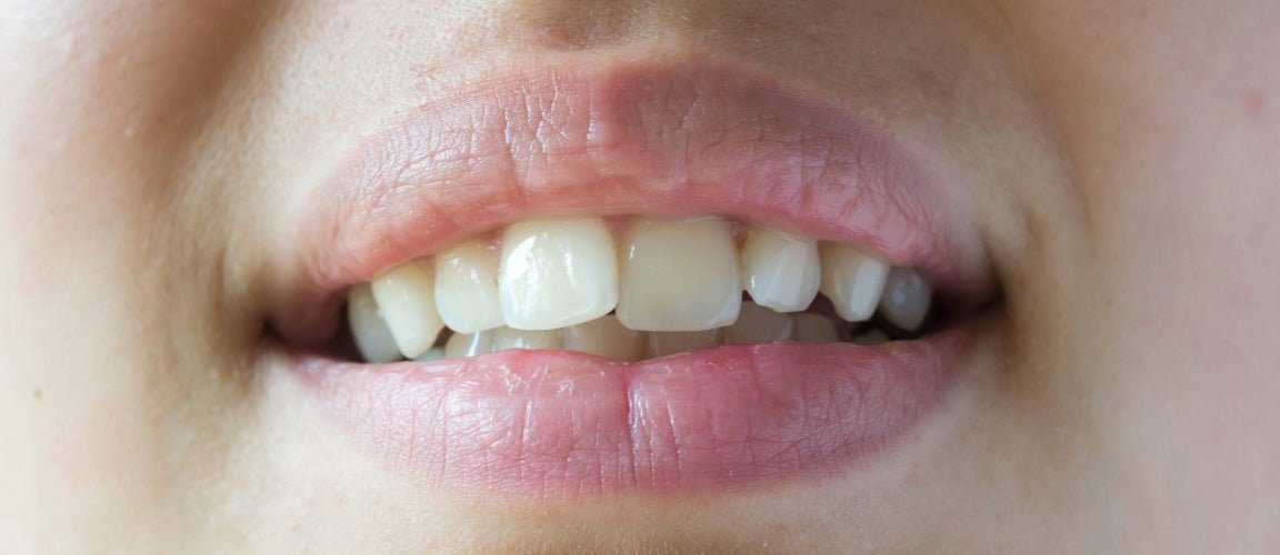 Crossbite: What It Is, Types, Causes, and How to Fix It - Diamond Braces