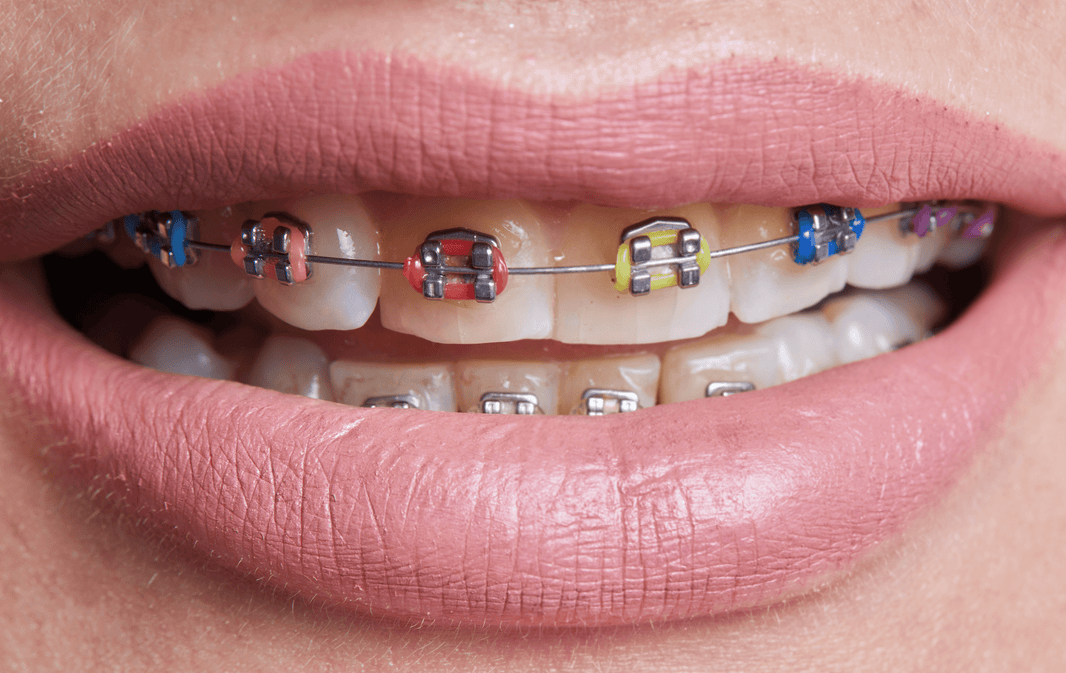 Do Braces Make Your Lips Bigger? During Treatment vs. After - Diamond Braces