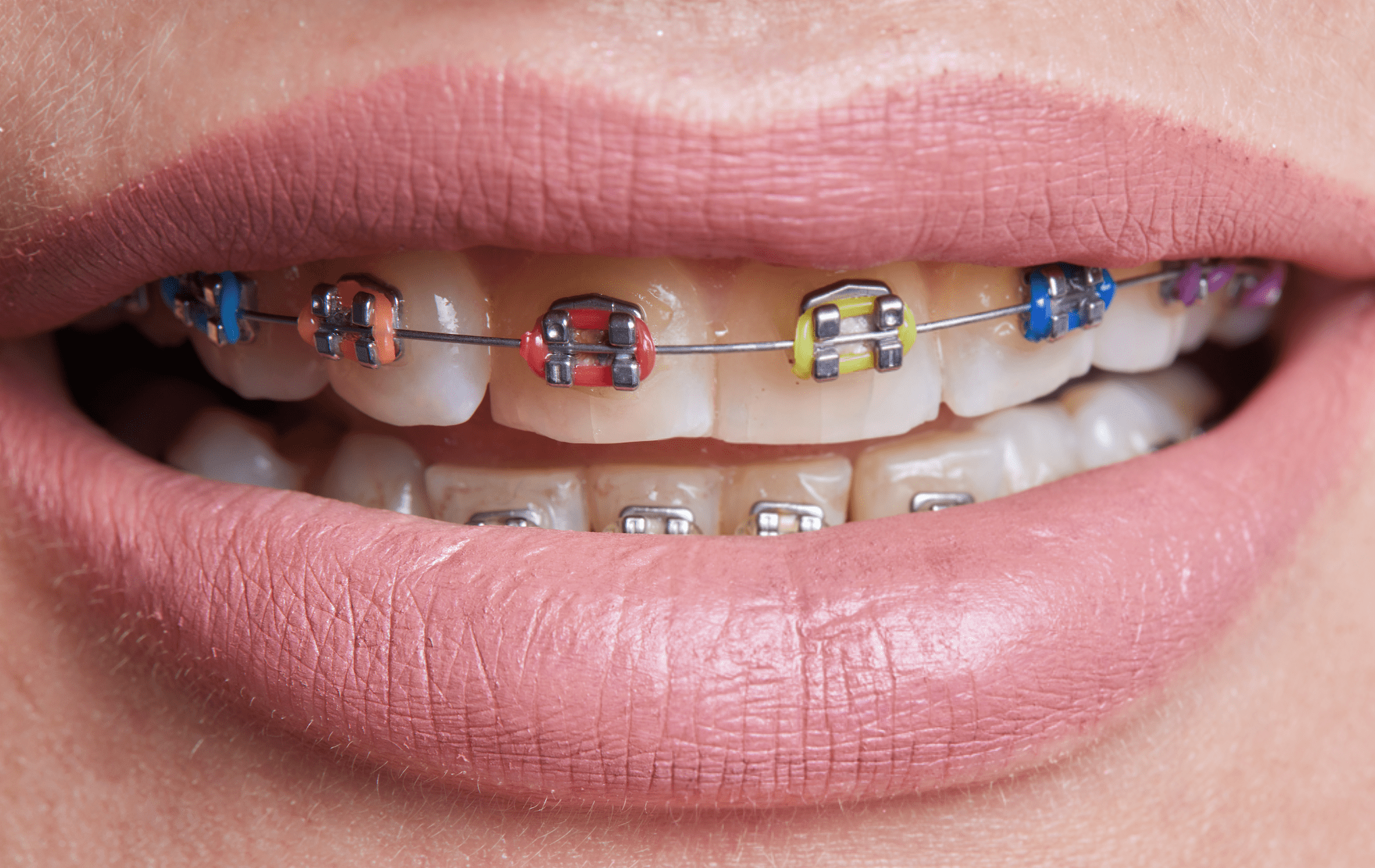 Do Braces Make Your Lips Bigger? During Treatment vs. After - Diamond Braces