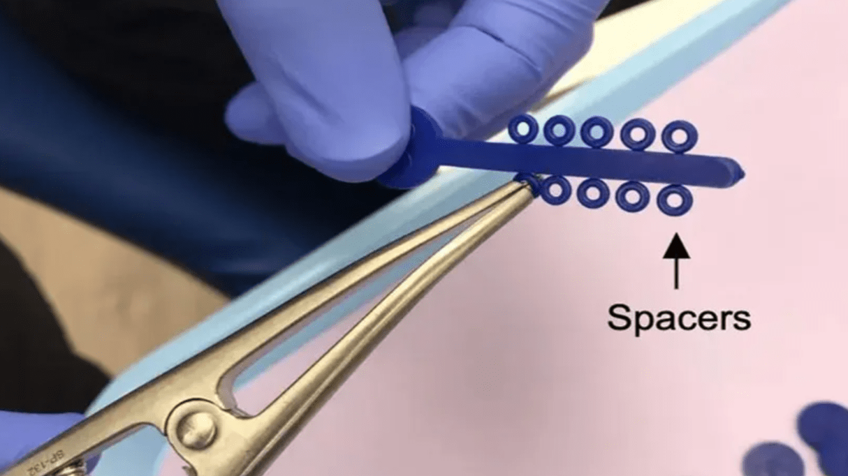 Everything You Need to Know About Seperators for Braces - Diamond Braces