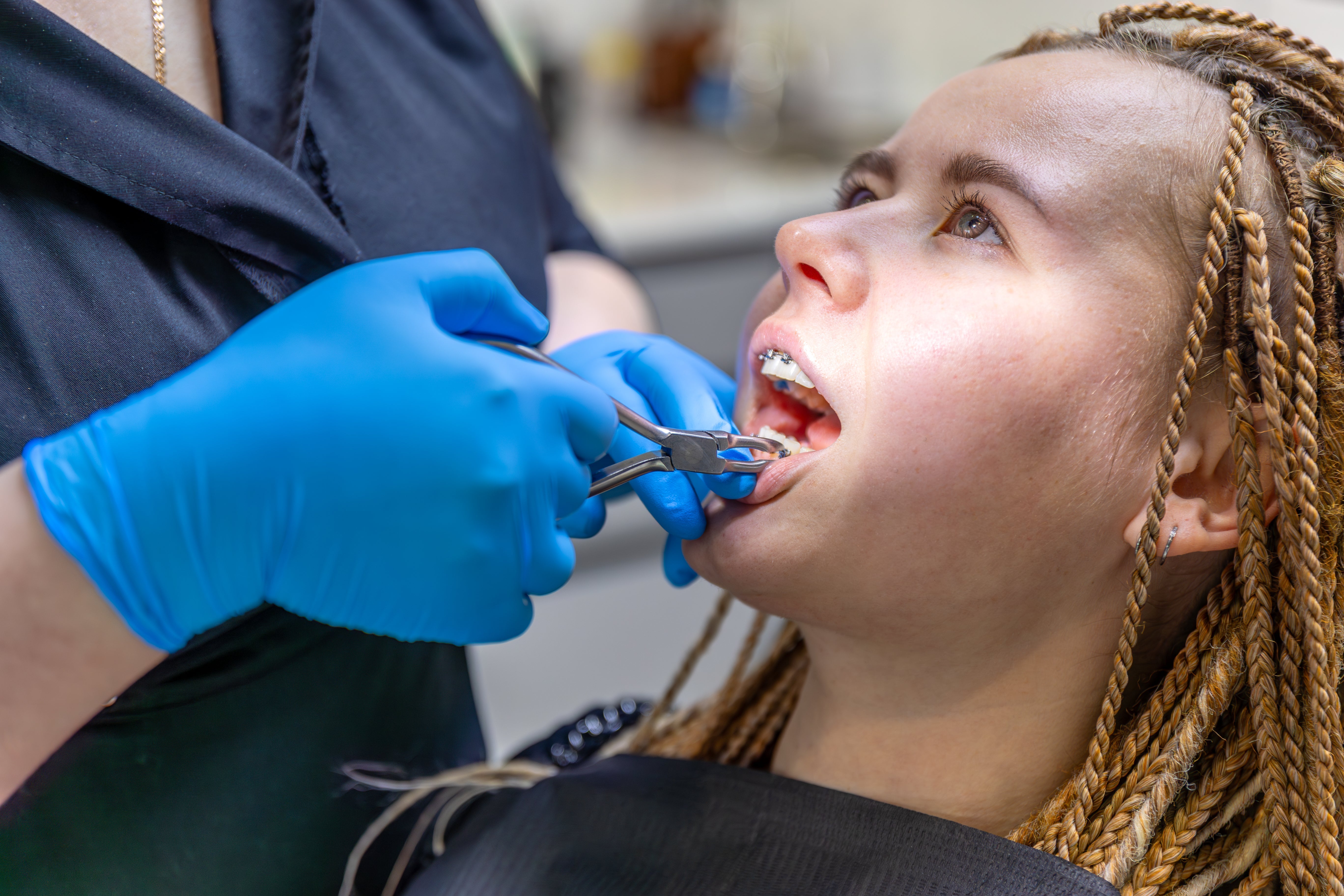 How Long Does Removing Braces Take? What to Expect - Diamond Braces