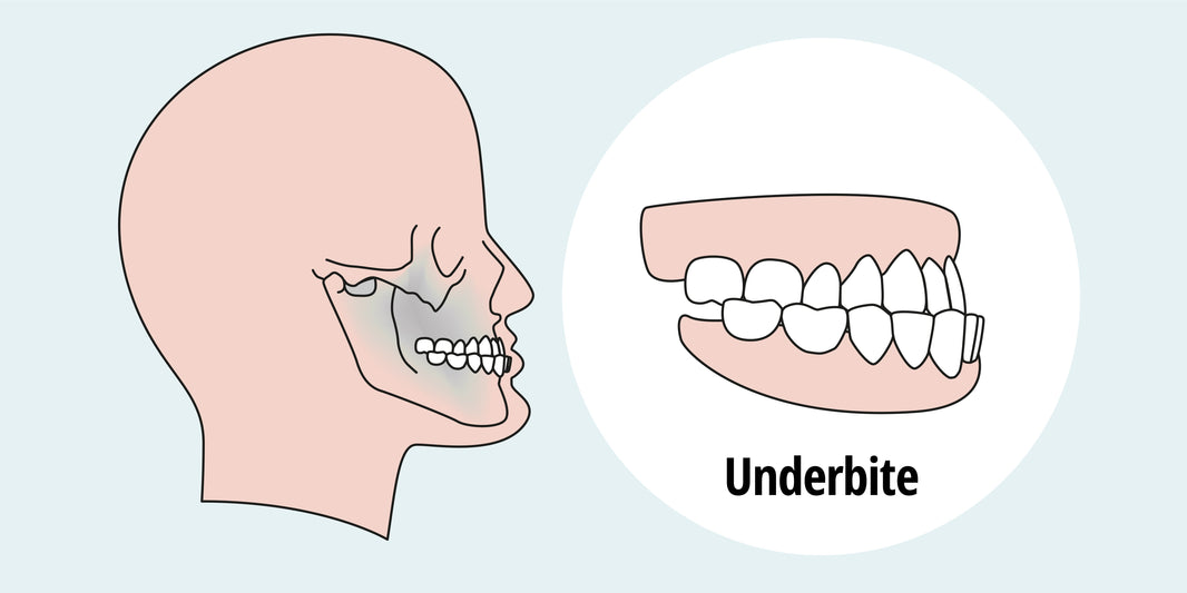How to Fix an Underbite: Causes, Types, and Treatment Options - Diamond Braces
