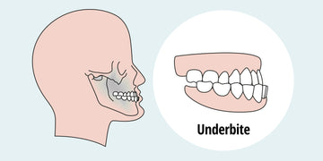 How to Fix an Underbite: Causes, Types, and Treatment Options – Diamond ...