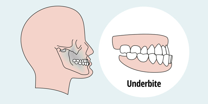 How to Fix an Underbite: Causes, Types, and Treatment Options – Diamond ...