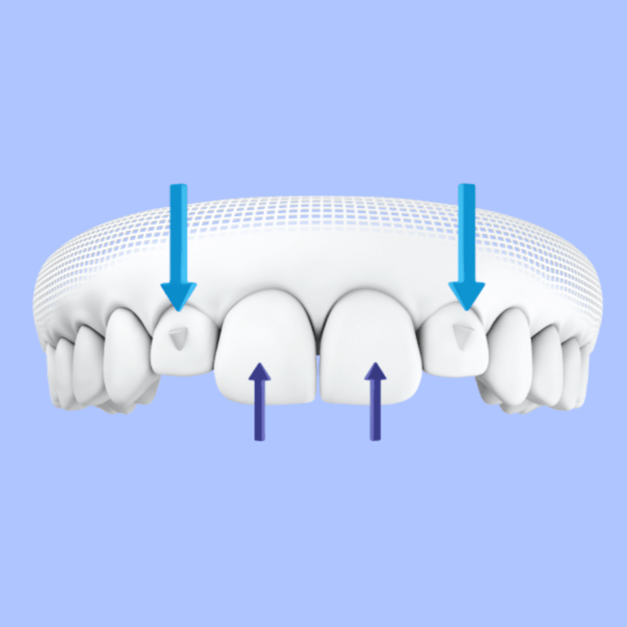 Invisalign Attachments (Buttons): What They Are & How They Work - Diamond Braces