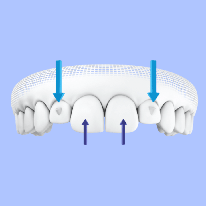 Invisalign Attachments: How They Work, Benefits, and Care – Diamond Braces