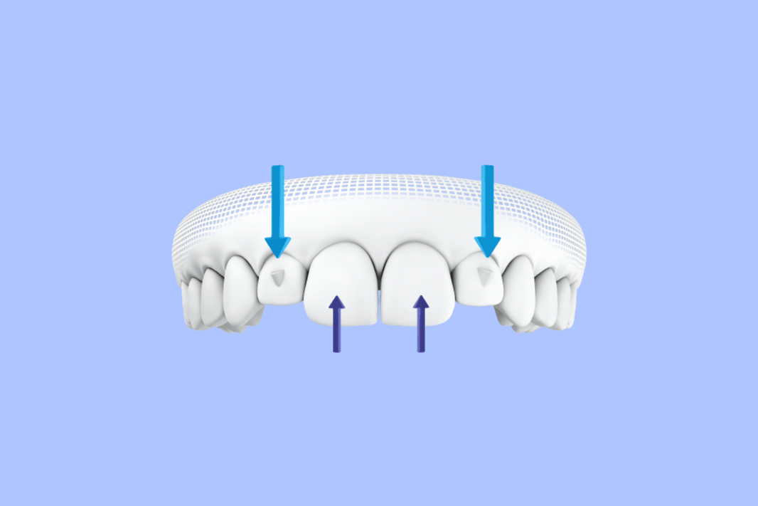 Invisalign Attachments (Buttons): What They Are & How They Work - Diamond Braces