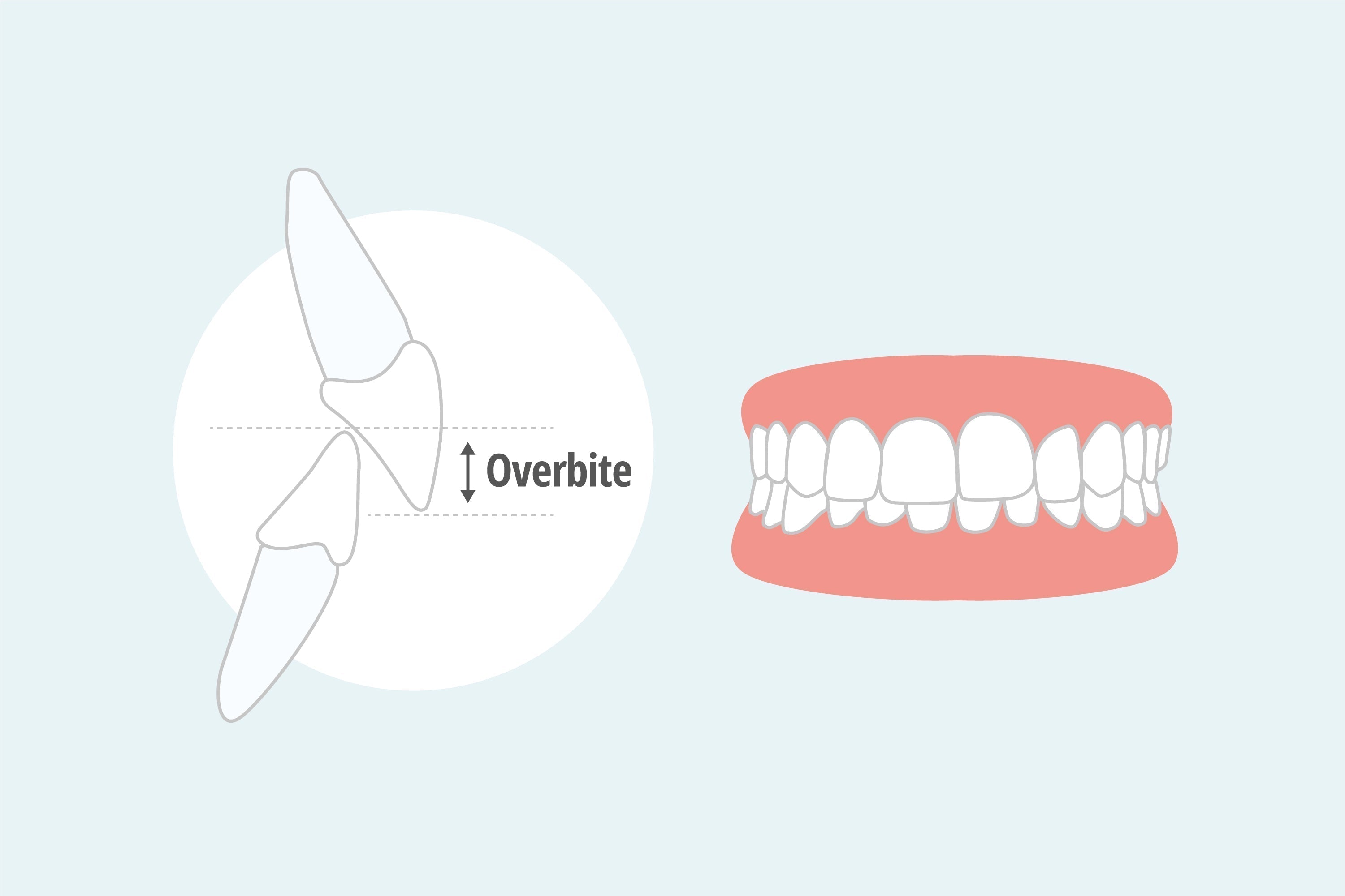 Overbite Before and After: What to Expect From Correction Treatment - Diamond Braces