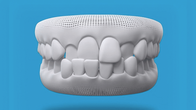 Front facing teeth with a removable retainer 