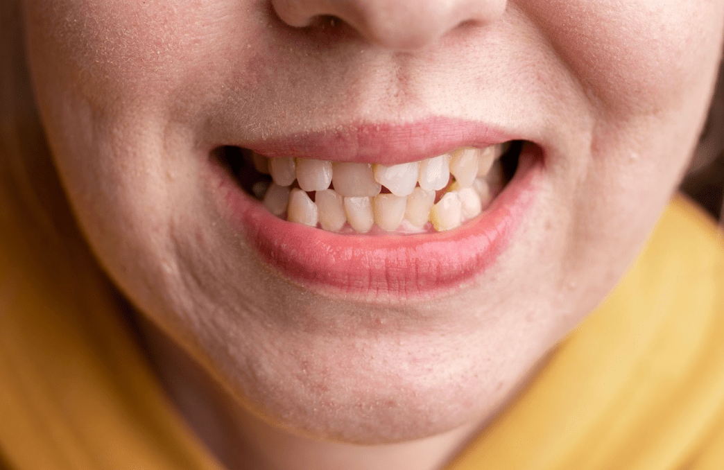 Smoothing Uneven Teeth: Safe and Effective Ways to Improve Your Smile - Diamond Braces