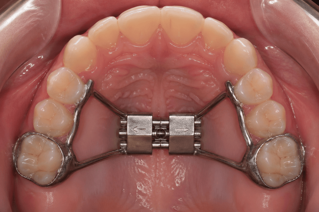 What Is a Palate Expander and What Is It Used For? - Diamond Braces