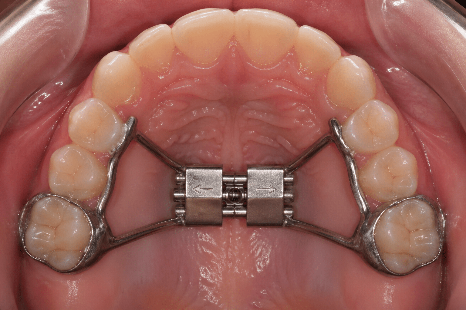 What Is a Palate Expander and What Is It Used For? - Diamond Braces