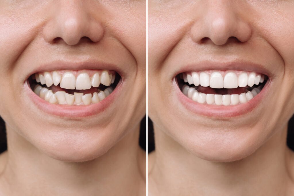 What to Do About Dental Crowding and Misaligned Teeth - Diamond Braces