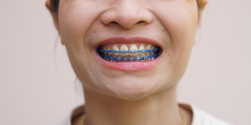 Braces - Diamond Braces