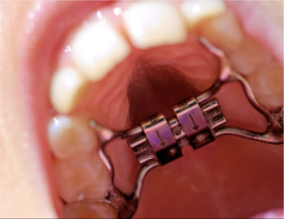 Close-up of a dental brace on a person's teeth