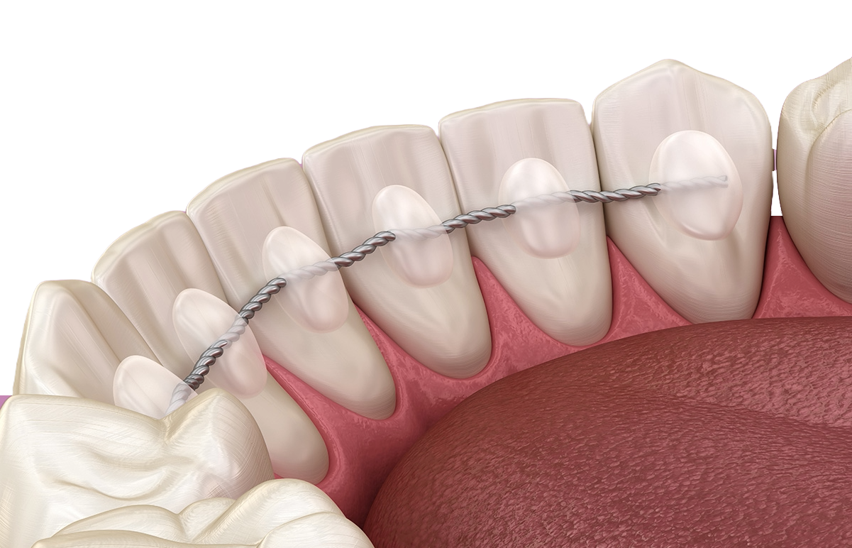 3D asset of a permanent retainer for teeth straightening. The view is from behind the teeth showing a metal wire along the bottom row with glue dots holding the teeth retainer in place.