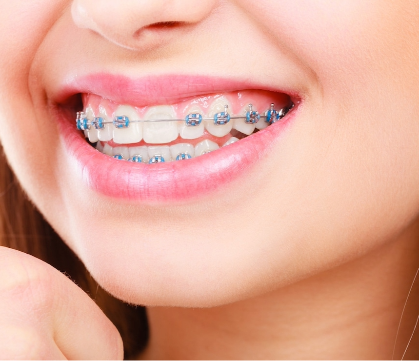 Close-up of a person with braces on their teeth, with a neutral background