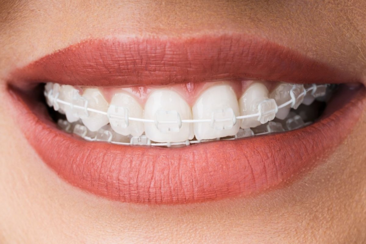 12 Months - Diamond Braces