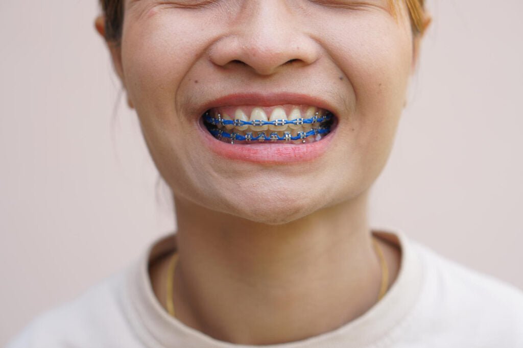 24 Months - Diamond Braces
