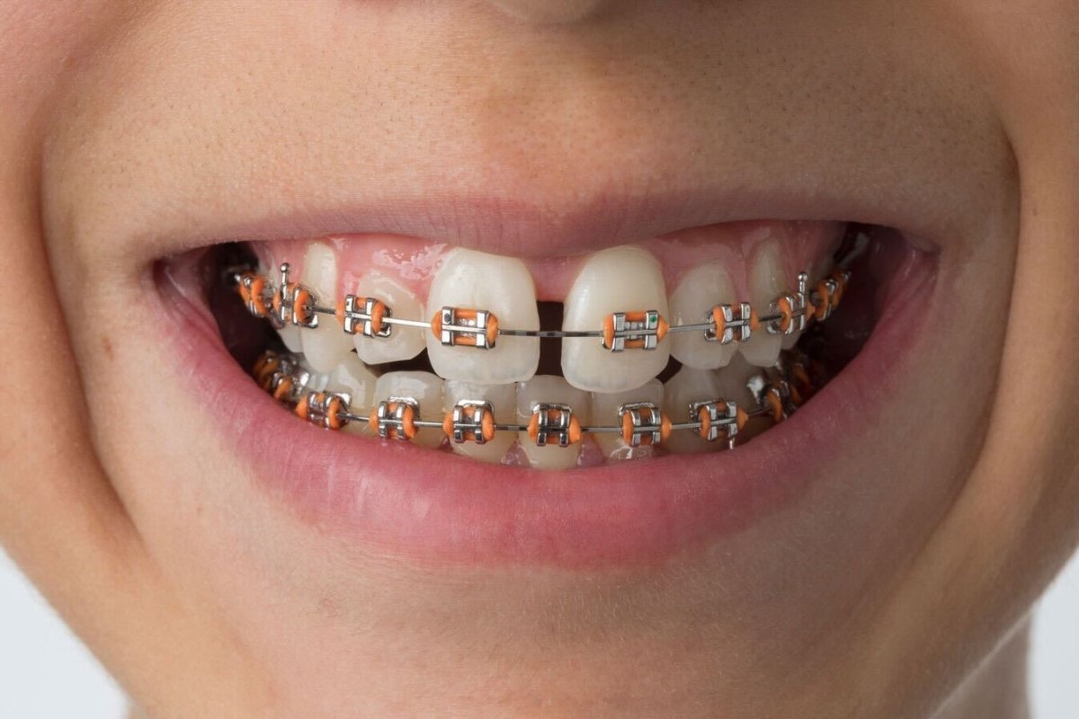 24 Months - Diamond Braces