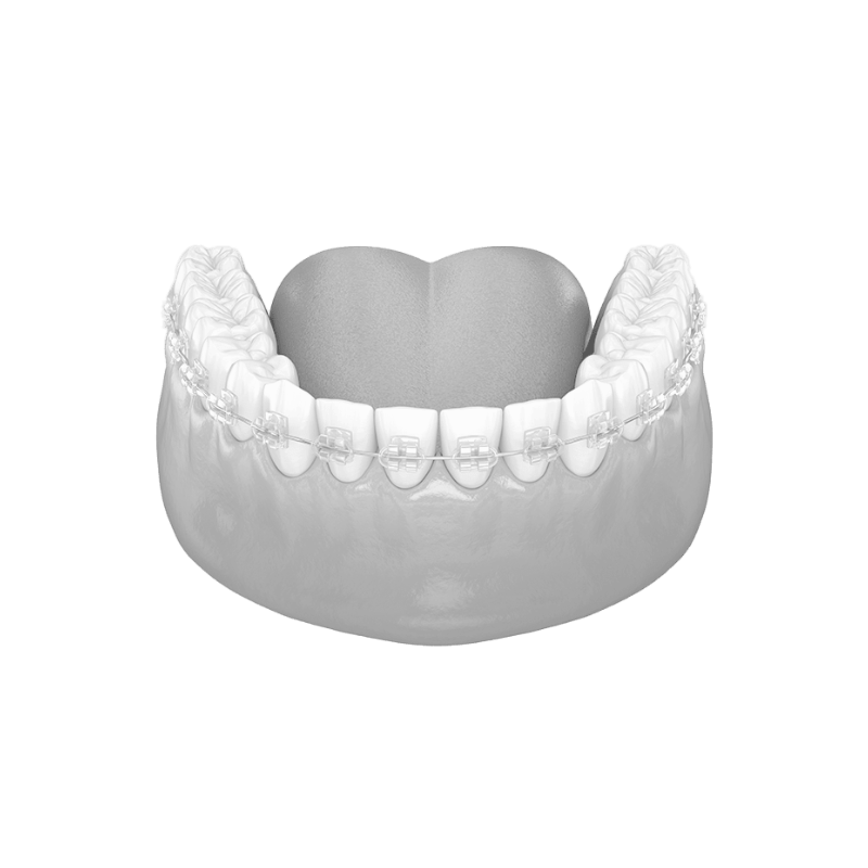 24 Months - Diamond Braces