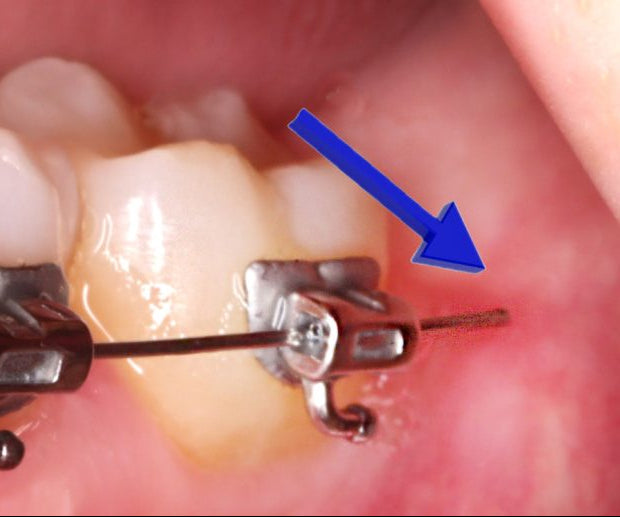 Close-up of dental braces on teeth with a blue arrow pointing to a specific area.