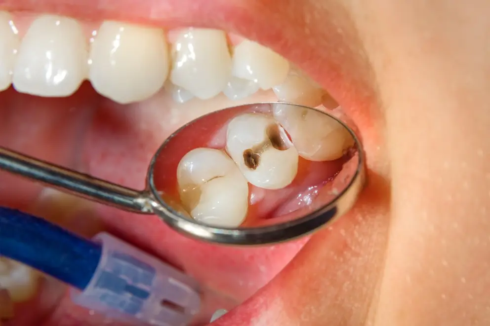 Can I Get a Filling While Wearing Braces? - Video Guide
